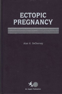 Ectopic Pregnancy